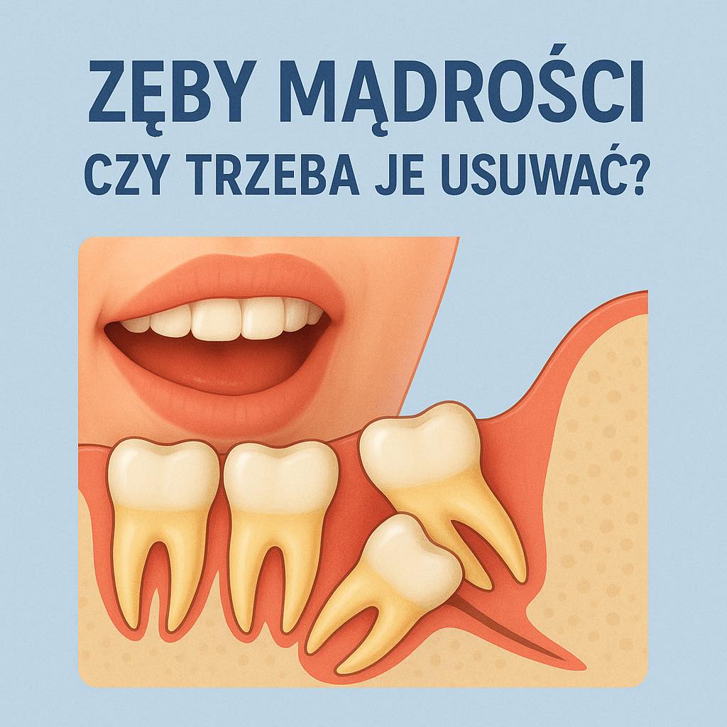 Zęby mądrości – czy trzeba je usuwać?